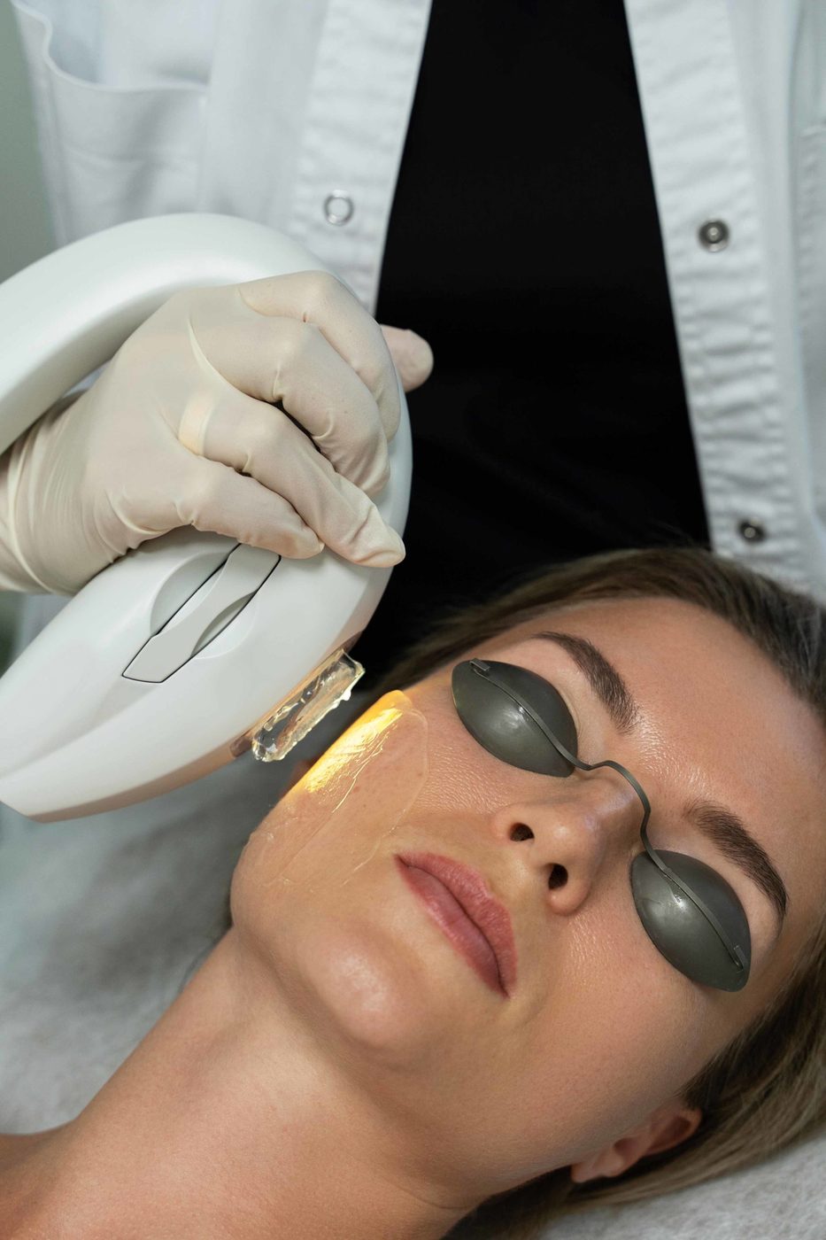 Acne reduction with light and laser at Glacial Lakes Aesthetics in Spicer, Minnesota
