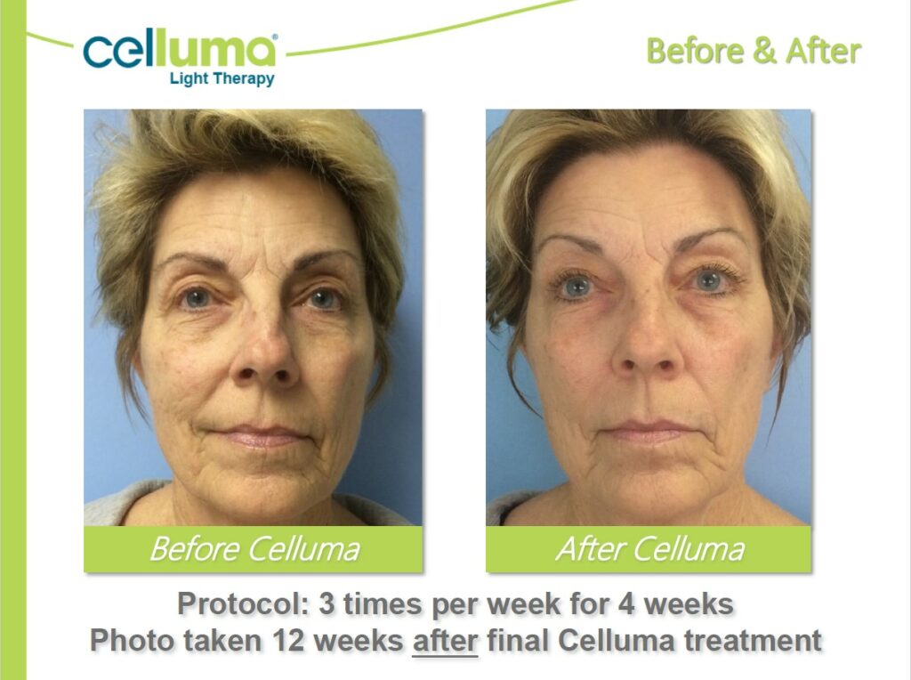 Celluma Light Therapy Before & After