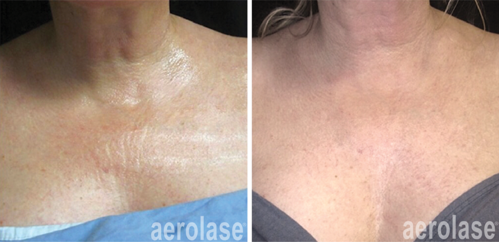 Aerolase Skin Rejuvenation & Tightening